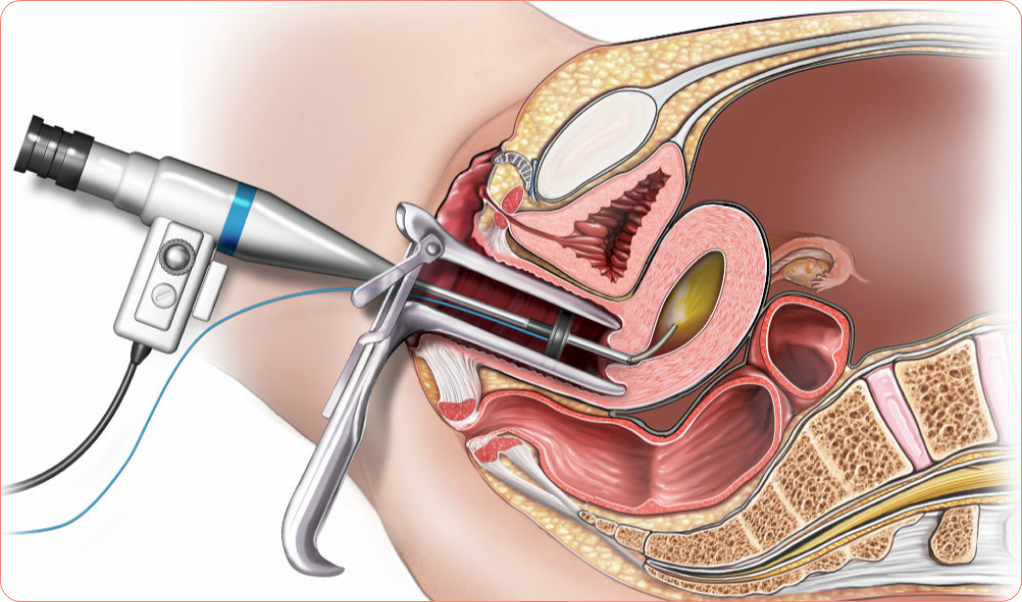 hysteroscopy